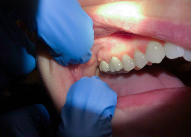 Best Emergency Treatment for Toothache in Chesterbrook, PA
